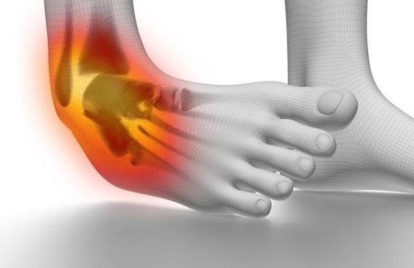 Sprain